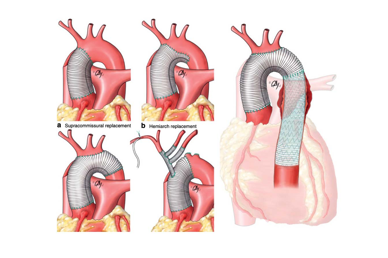 Aortic Surgery